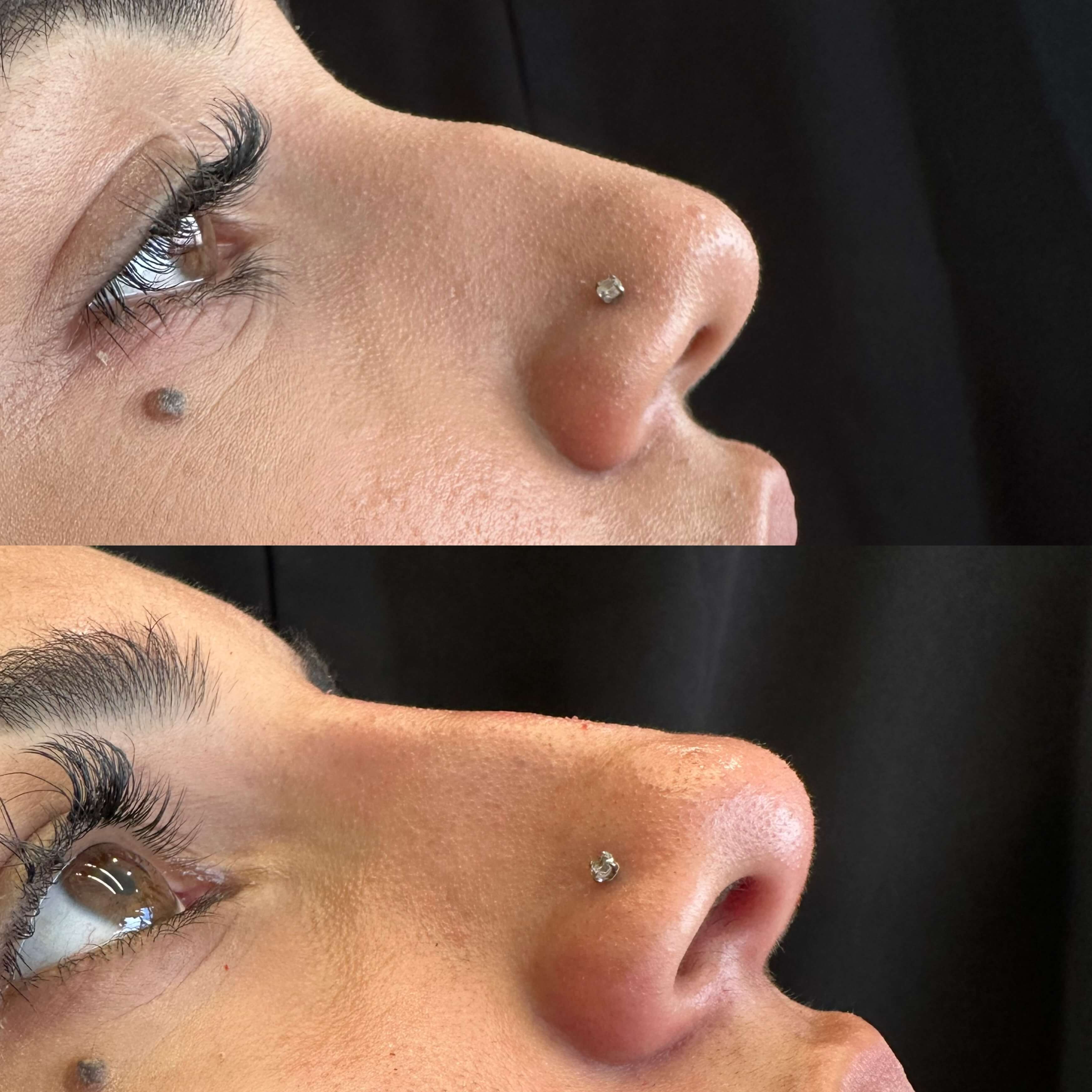 Harmonização orofacial completa