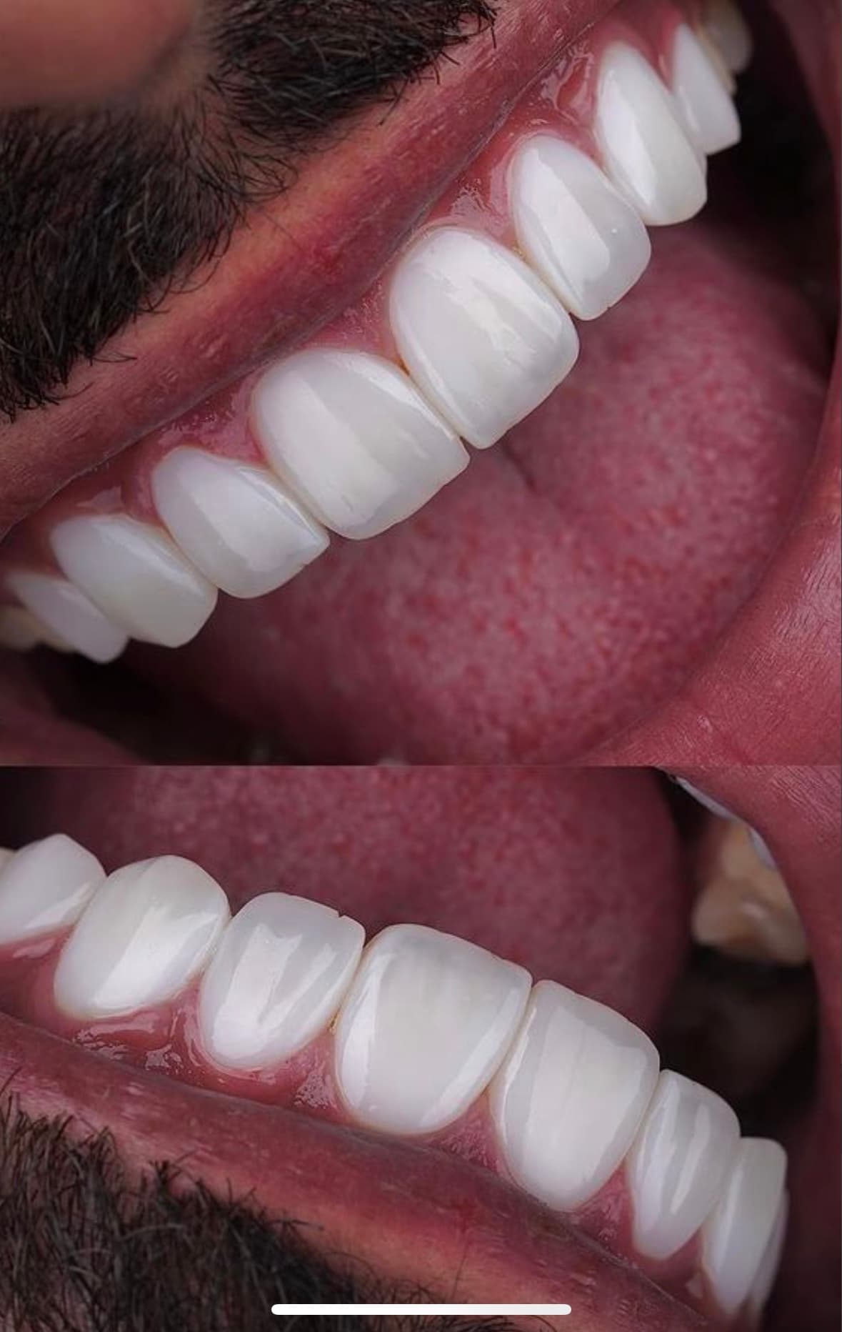 Transformação com lentes ultra-finas