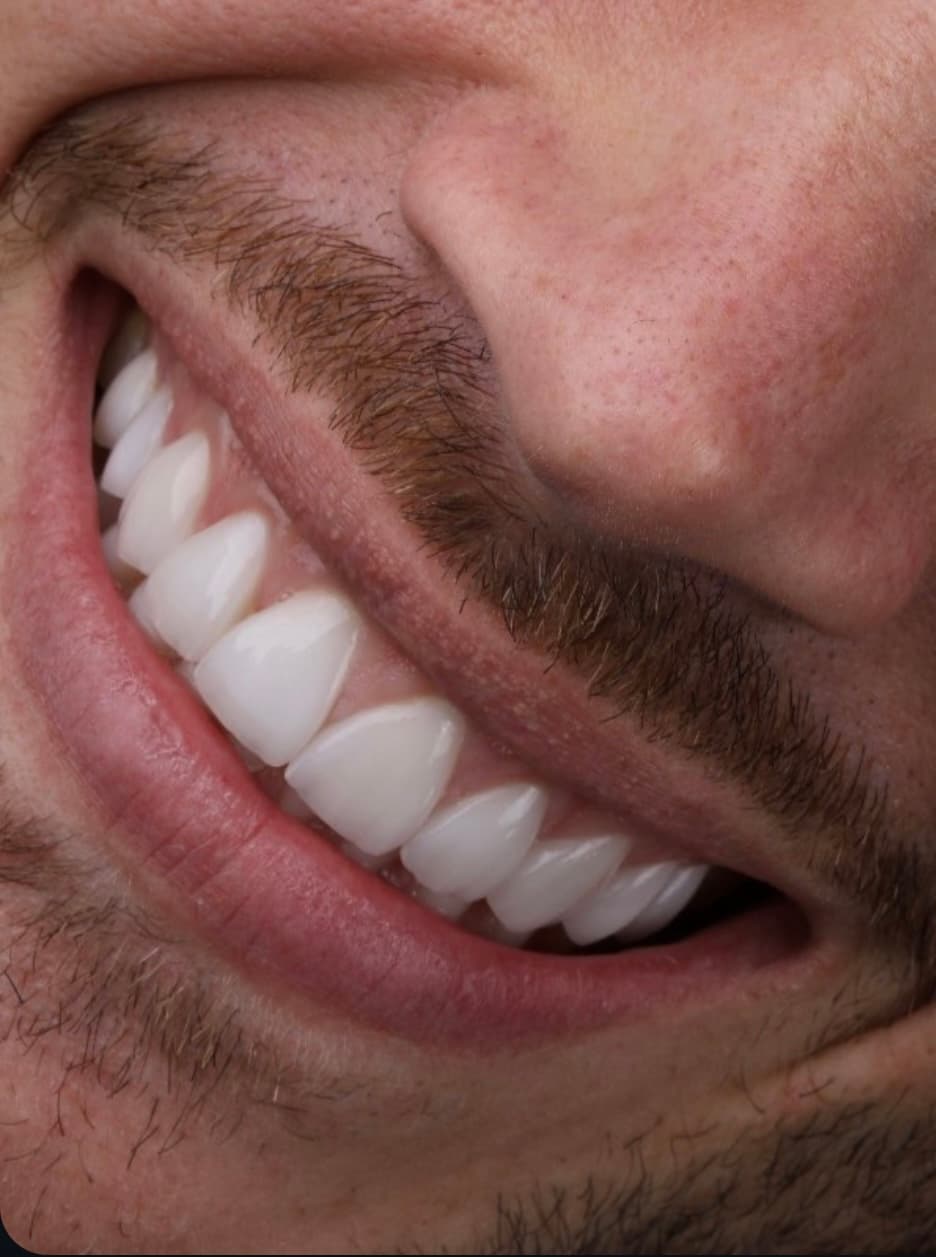 Sorriso perfeito e natural