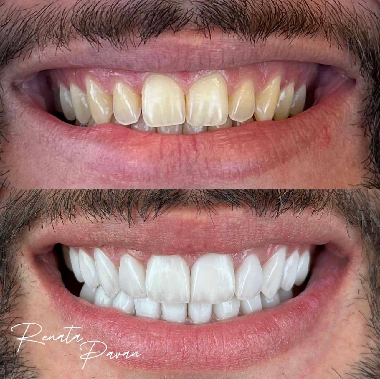 Lentes de porcelana ultrafinas